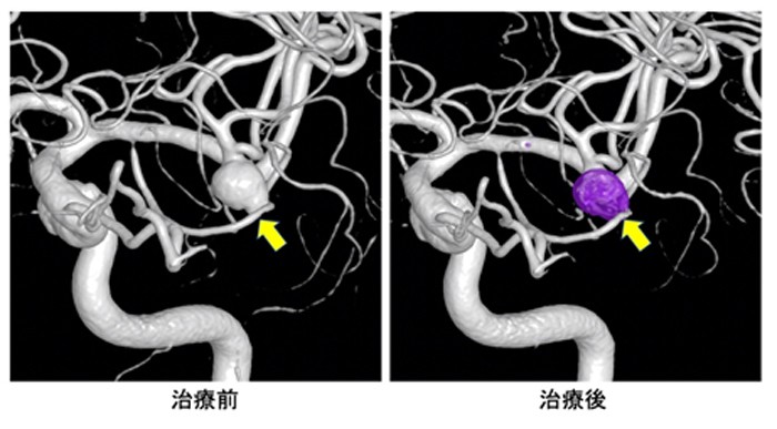 脳動脈瘤の血管内治療: 最新症例集 |本 | 通販 | Amazon